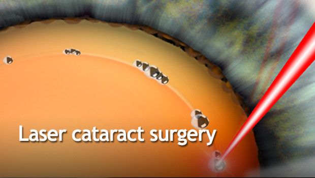 title-laser-cataract-surgery-620x350.jpg